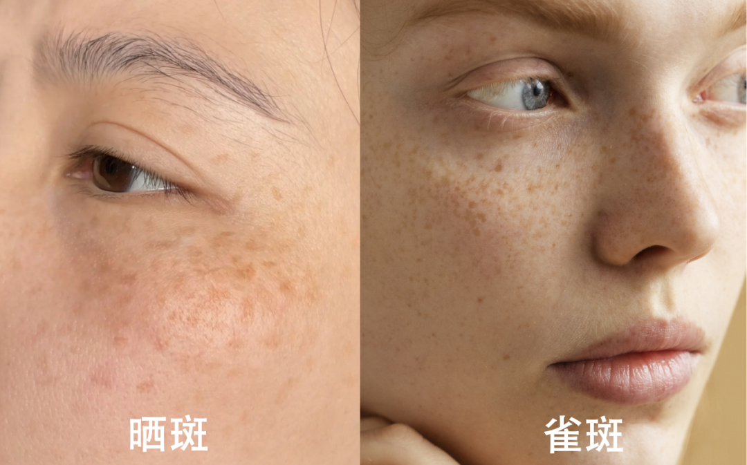 晒斑的预防与治疗