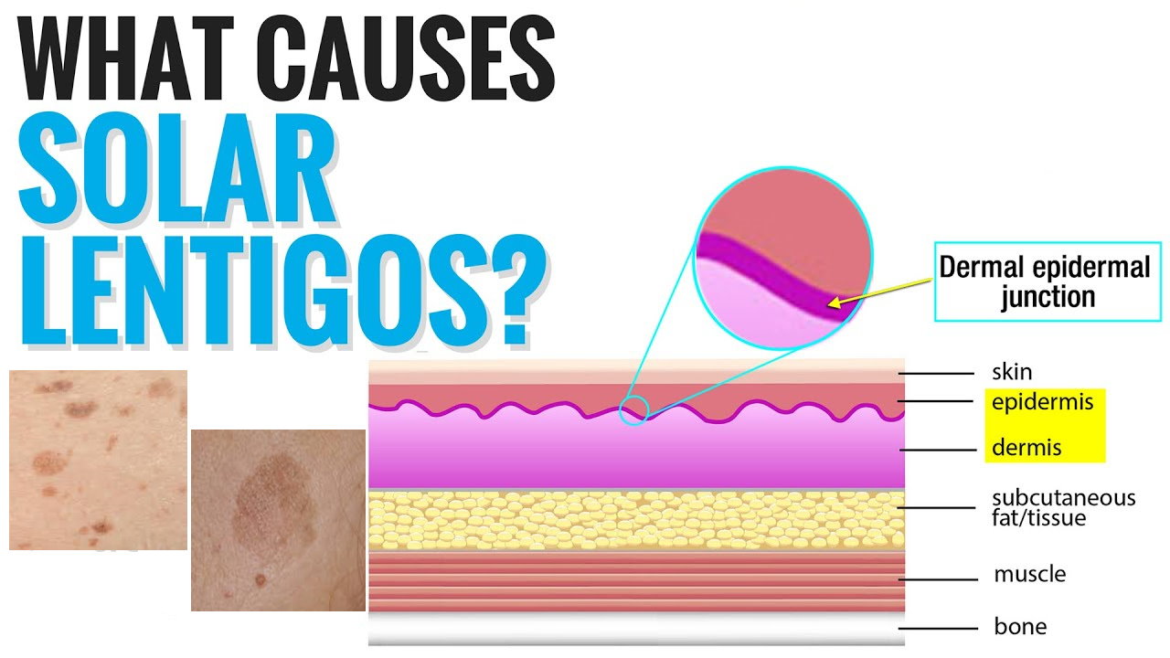 孚美达“氟轻松氢醌维A酸乳膏”能用于老年斑治疗吗？