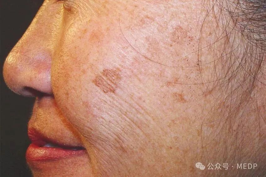 老年斑、晒斑、日光性雀斑是一回事吗？